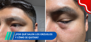 ¿Por qué salen los orzuelos y cómo se quitan?