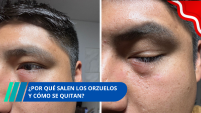 ¿Por qué salen los orzuelos y cómo se quitan?