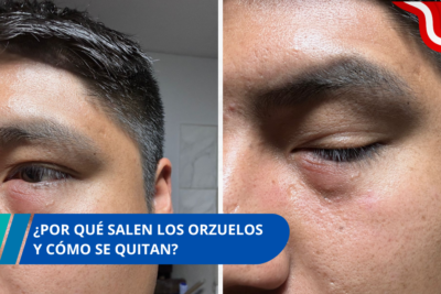 ¿Por qué salen los orzuelos y cómo se quitan?