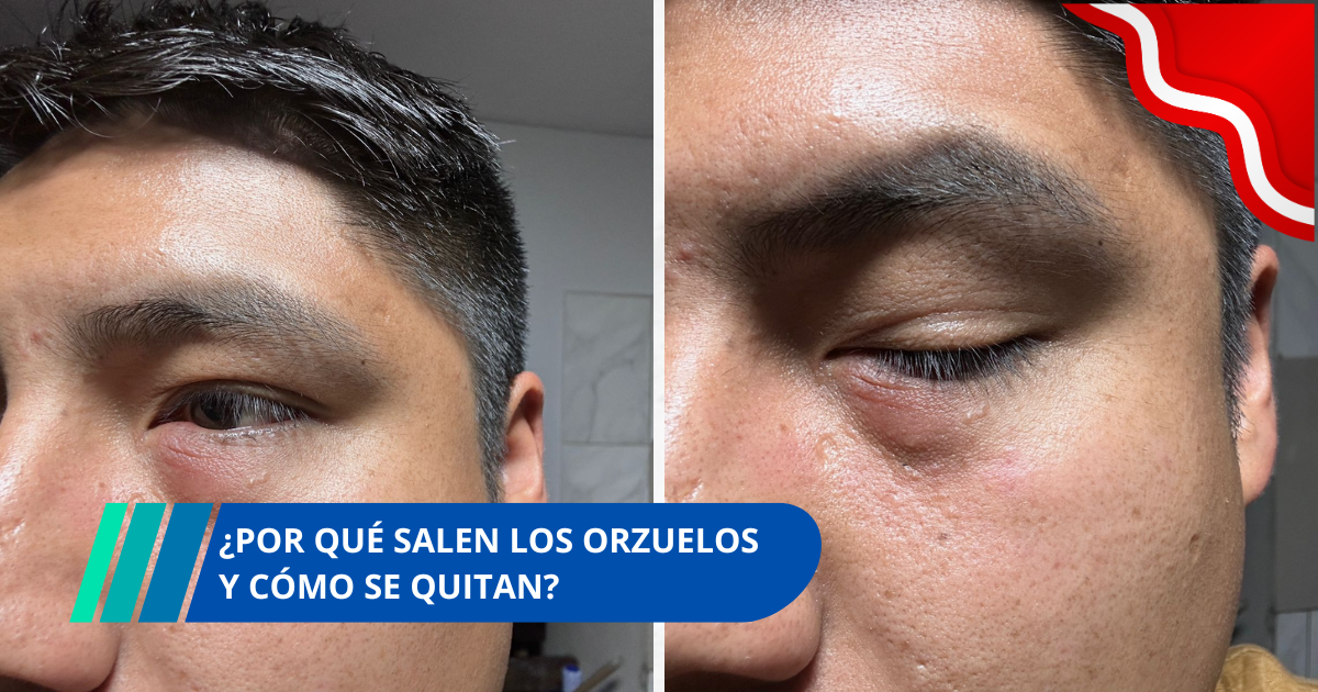 ¿Qué es un orzuelo en el ojo y como se quita?